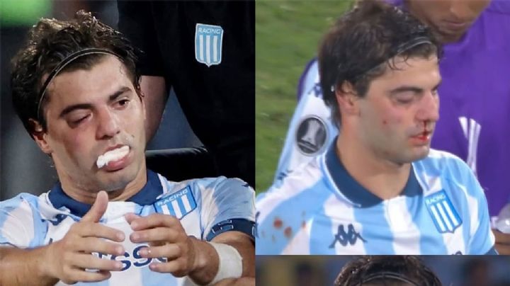 Marcos Rojo fracturó a Santi Sosa y así quedó el futbolista de Racing