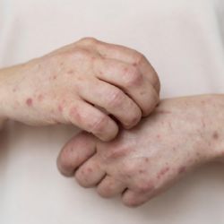 Alarma por el aumento de casos de sarampión en EEUU 