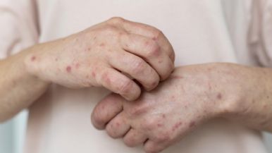 Foto iliustrativa de  Alarma por el aumento de casos de sarampión en EEUU 