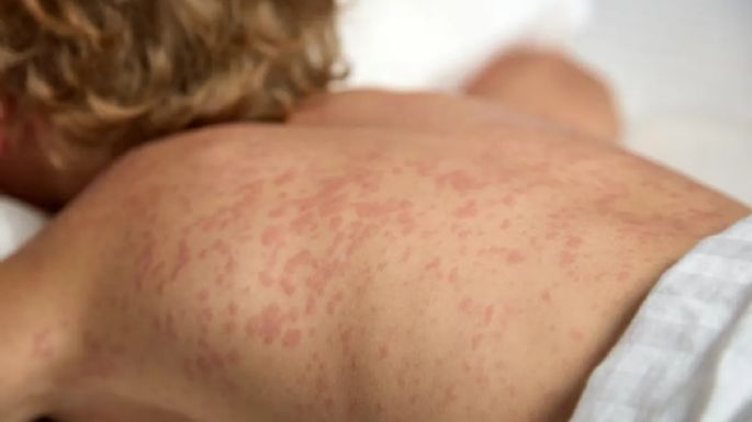 El ministerio de Salud de Mendoza pidió fortalecer la vigilancia por casos de sarampión