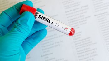 En 2025 se registraron más de 50 mil casos de sífilis en Argentina