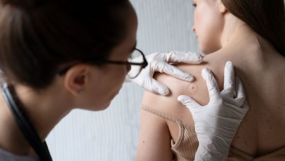 Cáncer de piel: la importancia del diagnóstico temprano