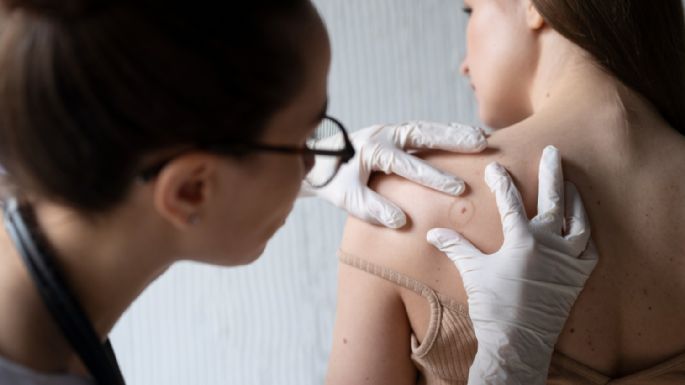 Cáncer de piel: la importancia del diagnóstico temprano