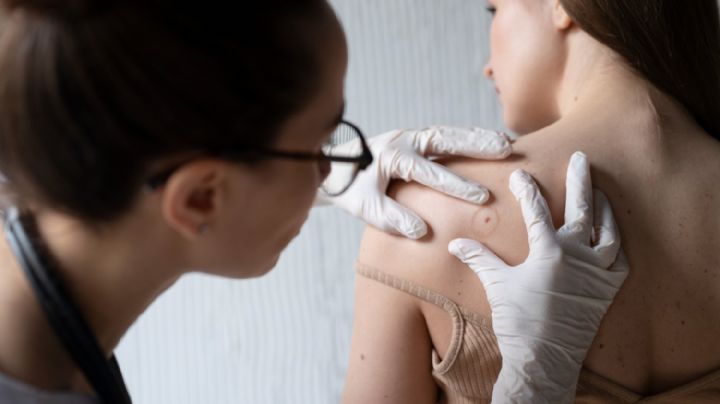 Cáncer de piel: la importancia del diagnóstico temprano