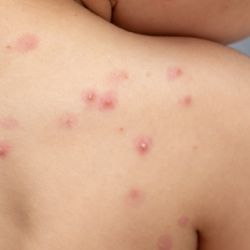 Confirmaron cinco casos de viruela del mono en Mendoza