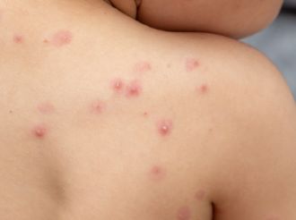 Se registraron cuatro nuevos casos de viruela del mono y ya suman 15 