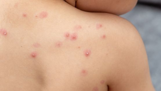 Confirmaron cinco casos de viruela del mono en Mendoza