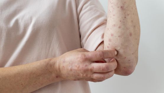 Alerta por un caso importado de sarampión en la Argentina 