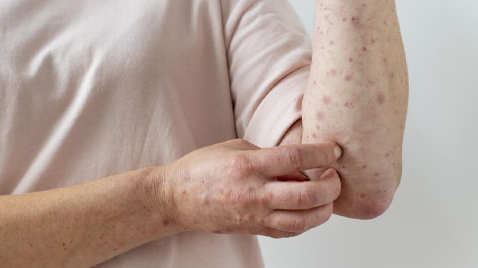 Alerta por un caso importado de sarampión en la Argentina 