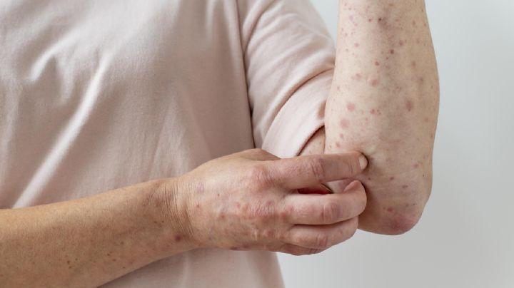 Alerta por un caso importado de sarampión en la Argentina 